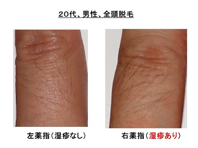 円形脱毛症　病院